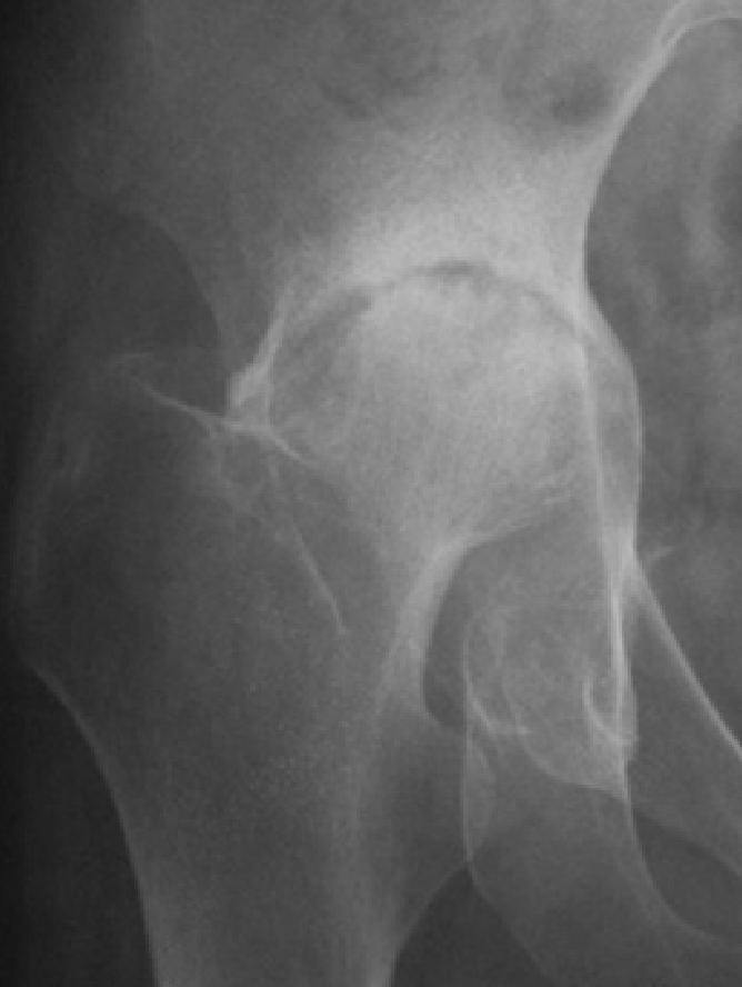 リウマチ性股関節症