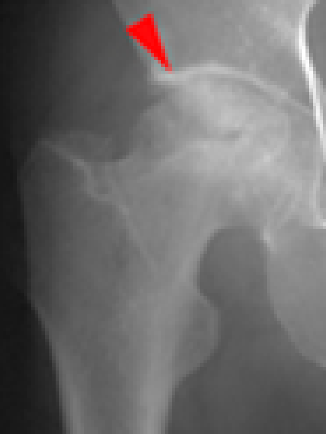 大腿骨頭壊死症