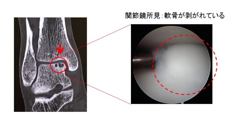 距骨骨軟骨損傷のCT画像