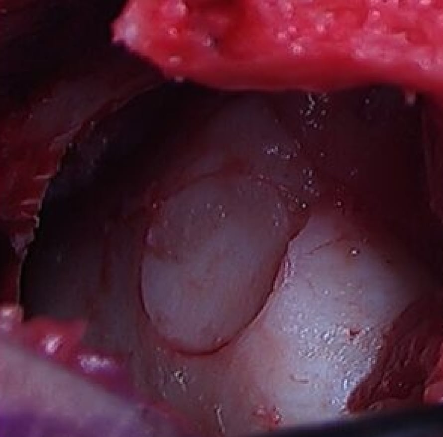 骨軟骨柱移植後