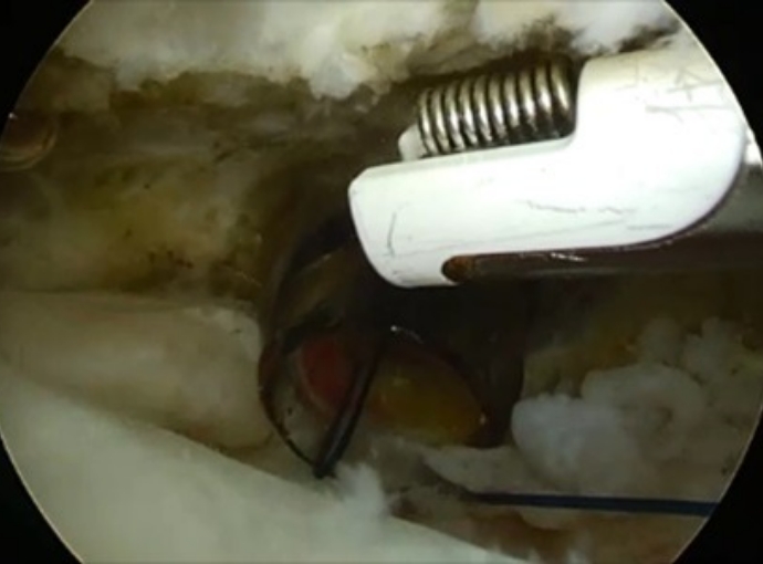 滑膜切除、肩峰下除圧の様子2