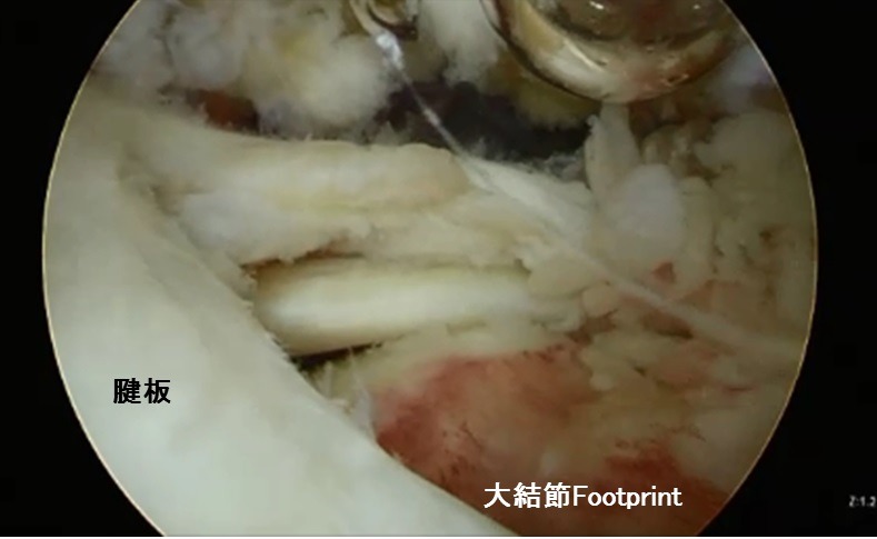 腱板縫合の画像