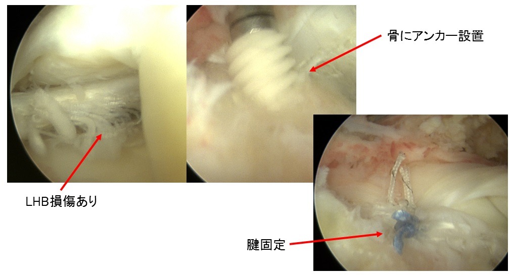 LHBの腱固定の画像