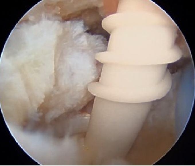 内側アンカー設置3