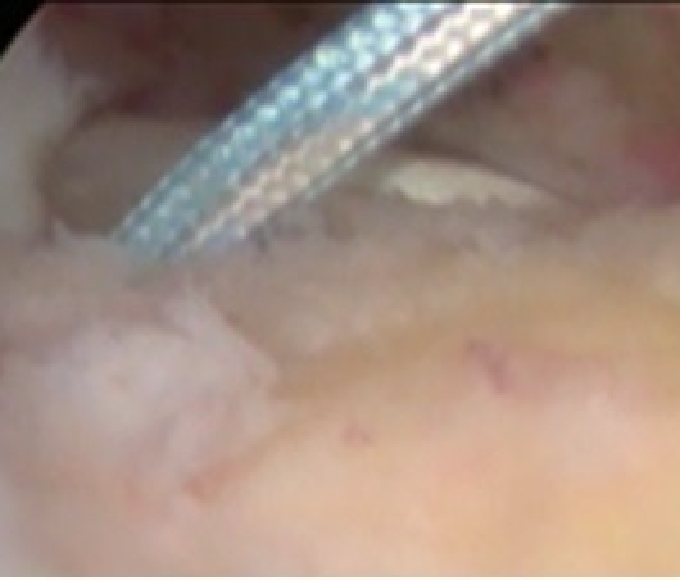 内側アンカー設置4