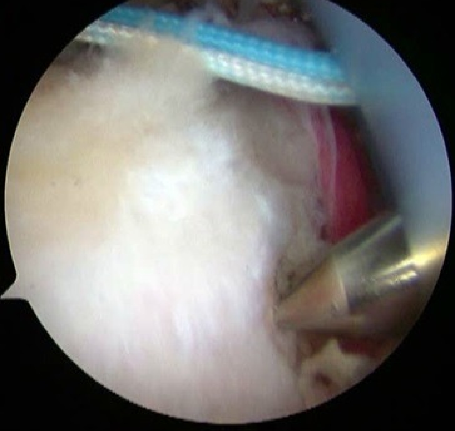 外側アンカー設置1