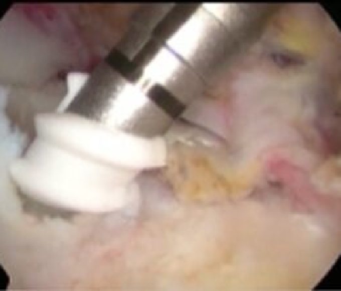 内側アンカー設置2