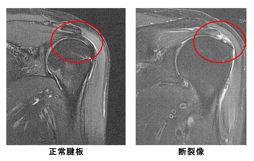 MRIでの正常腱板と断裂像