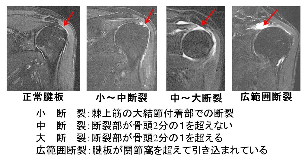 MRIでの腱板断裂の大きさの分類