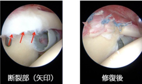 関節唇修復の画像