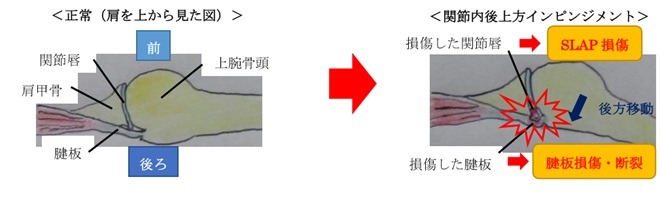 インピンジメントのメカニズム