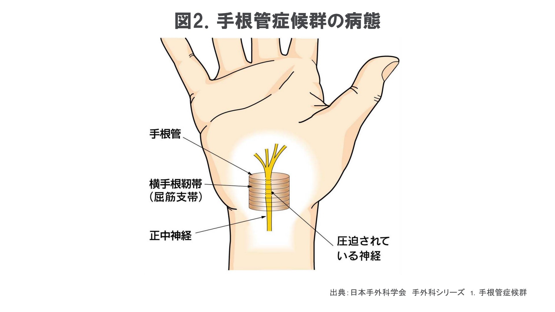手根管の構造図