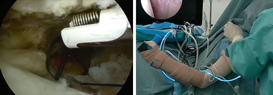 クリーニング手術の様子