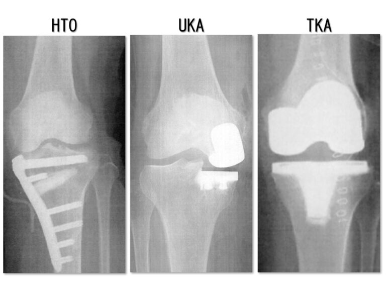 HTO・UKA・TKAのレントゲン画像