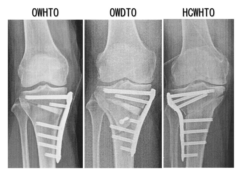 open wedgeとclose wedgeの画像