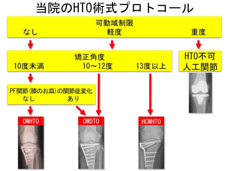 当院のHTO術式プロトコール図解
