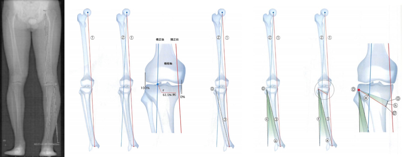 立位下肢全長Xp画像