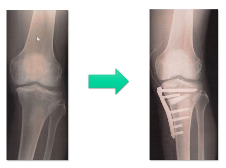 術前後のXp比較画像