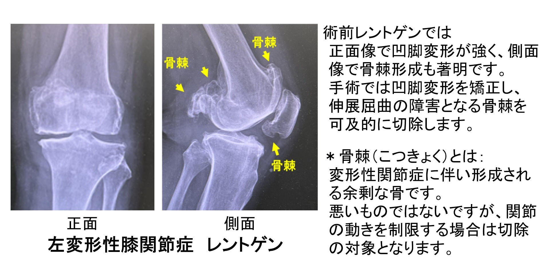 膝の3次元計画1