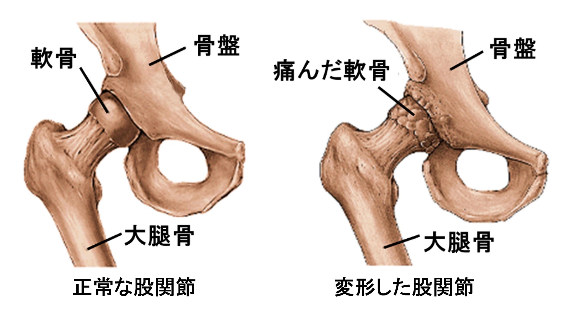 変形性股関節症のイメージ