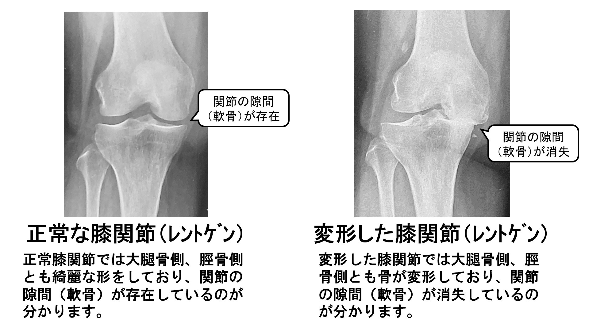 膝関節のレントゲン