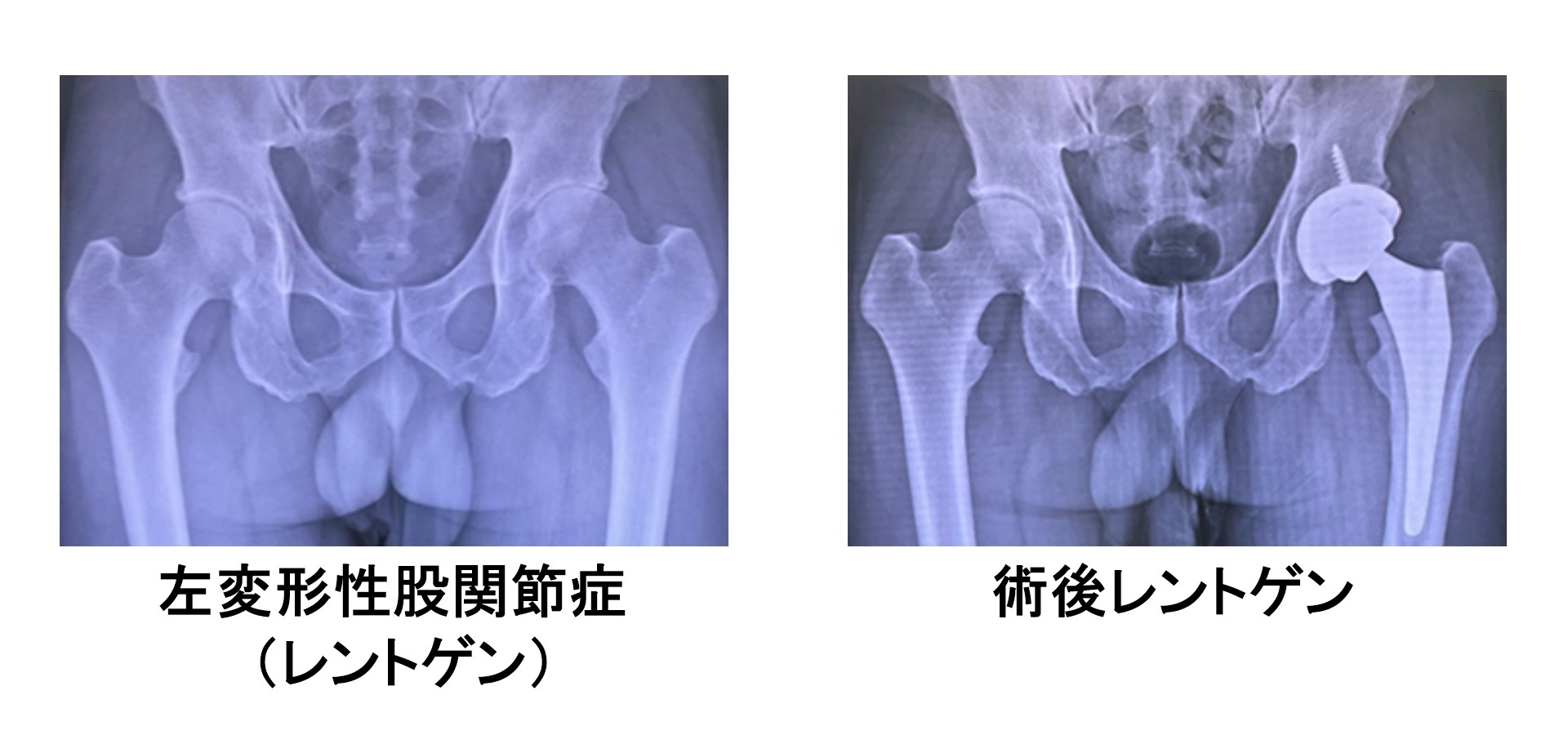 人工股関節の仕組み2