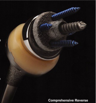 リバース型人工肩関節の構造2