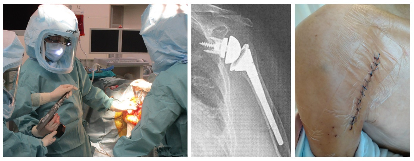 リバース人工肩関節