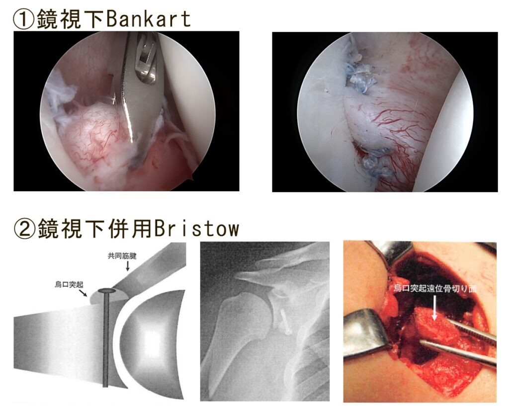 反復性肩関節脱臼