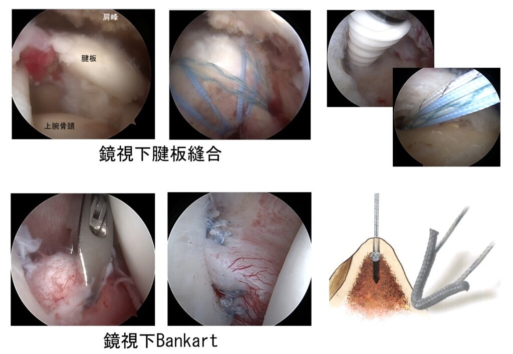 肩関節鏡手術とは