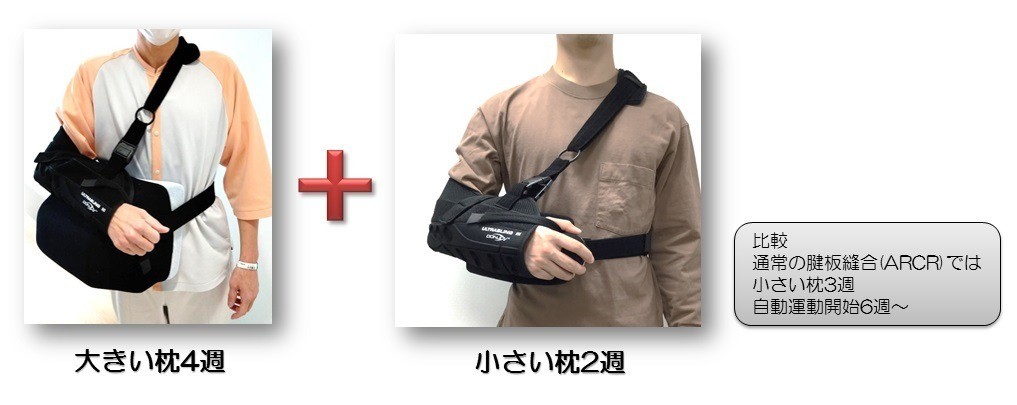 鏡視下上方関節包再建（ASCR）