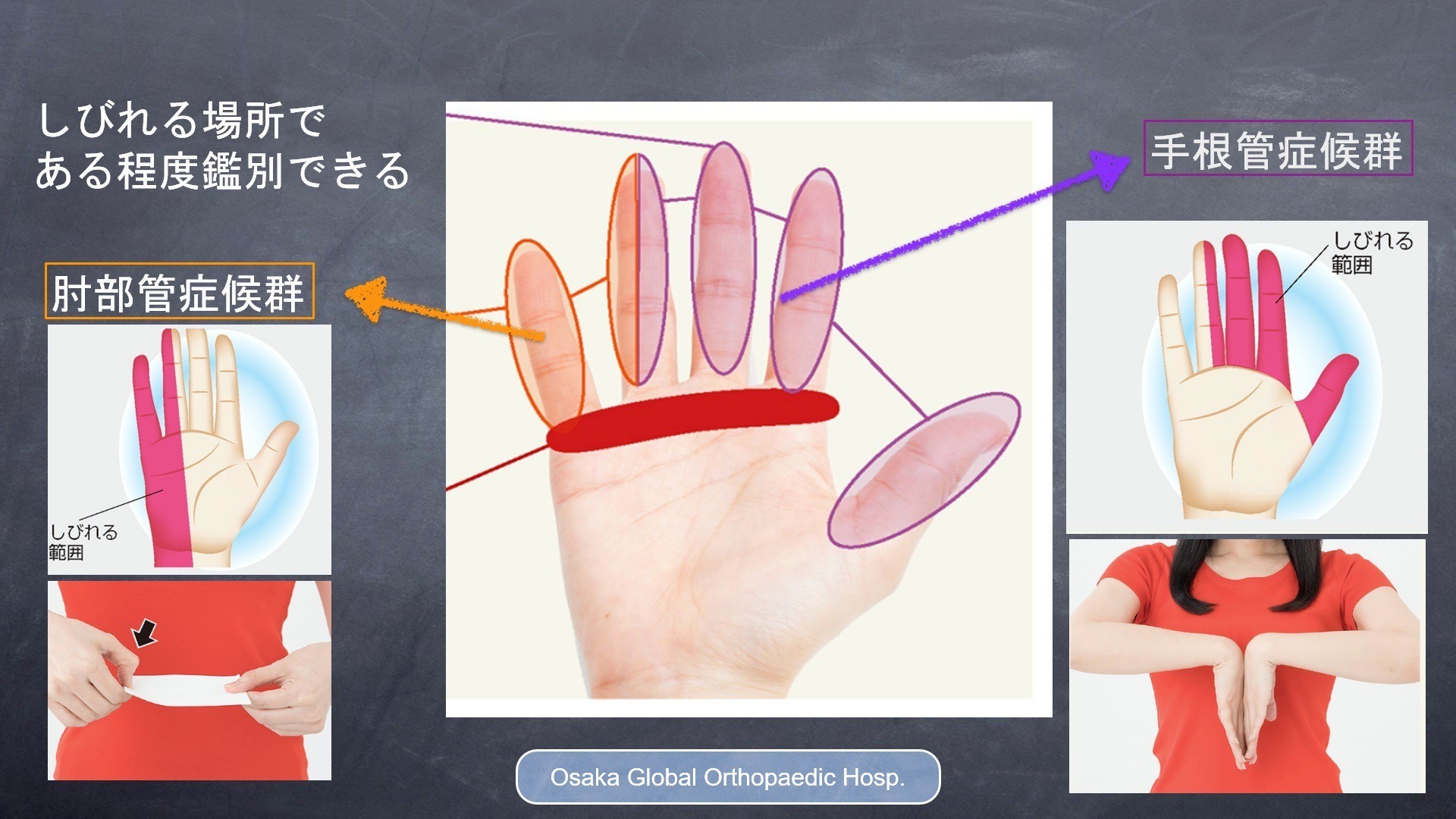 当院の手根管症候群に対する最小侵襲手術