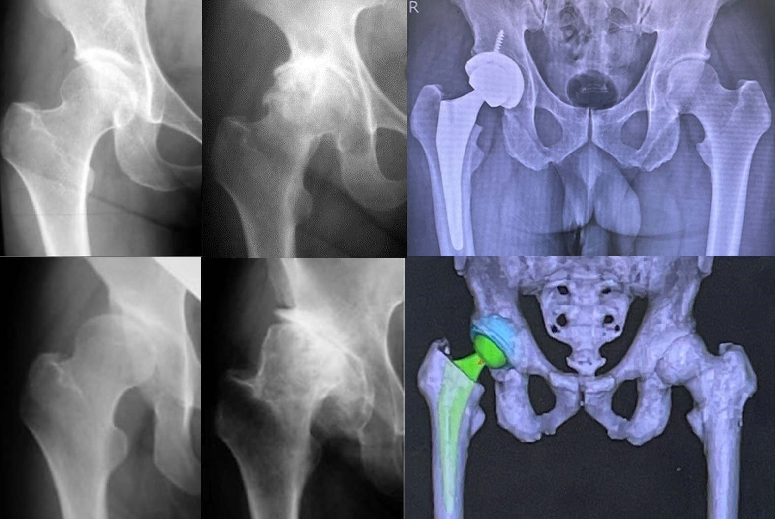変形性股関節症の症状と治療