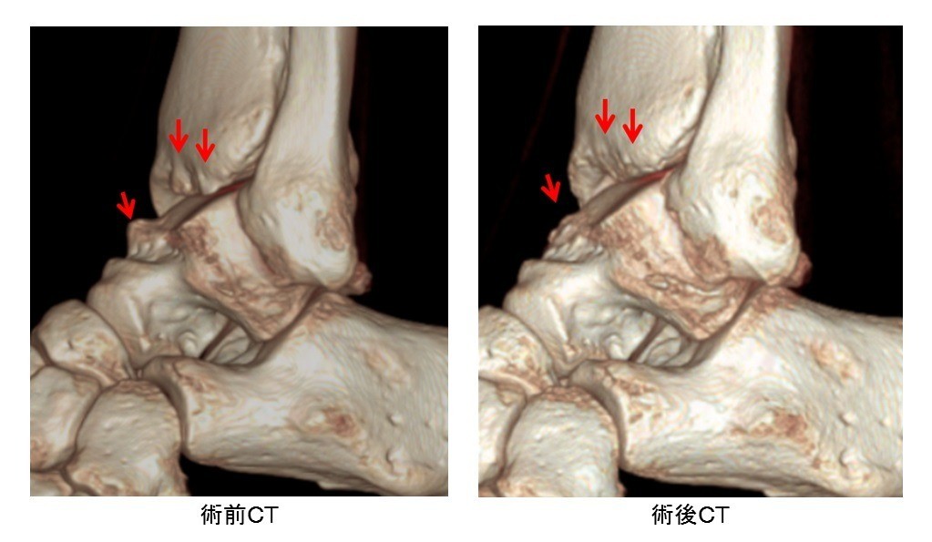 前方インピンジメント症候群