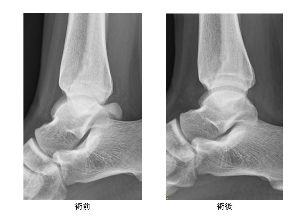 後方インピンジメント症候群（三角骨障害）