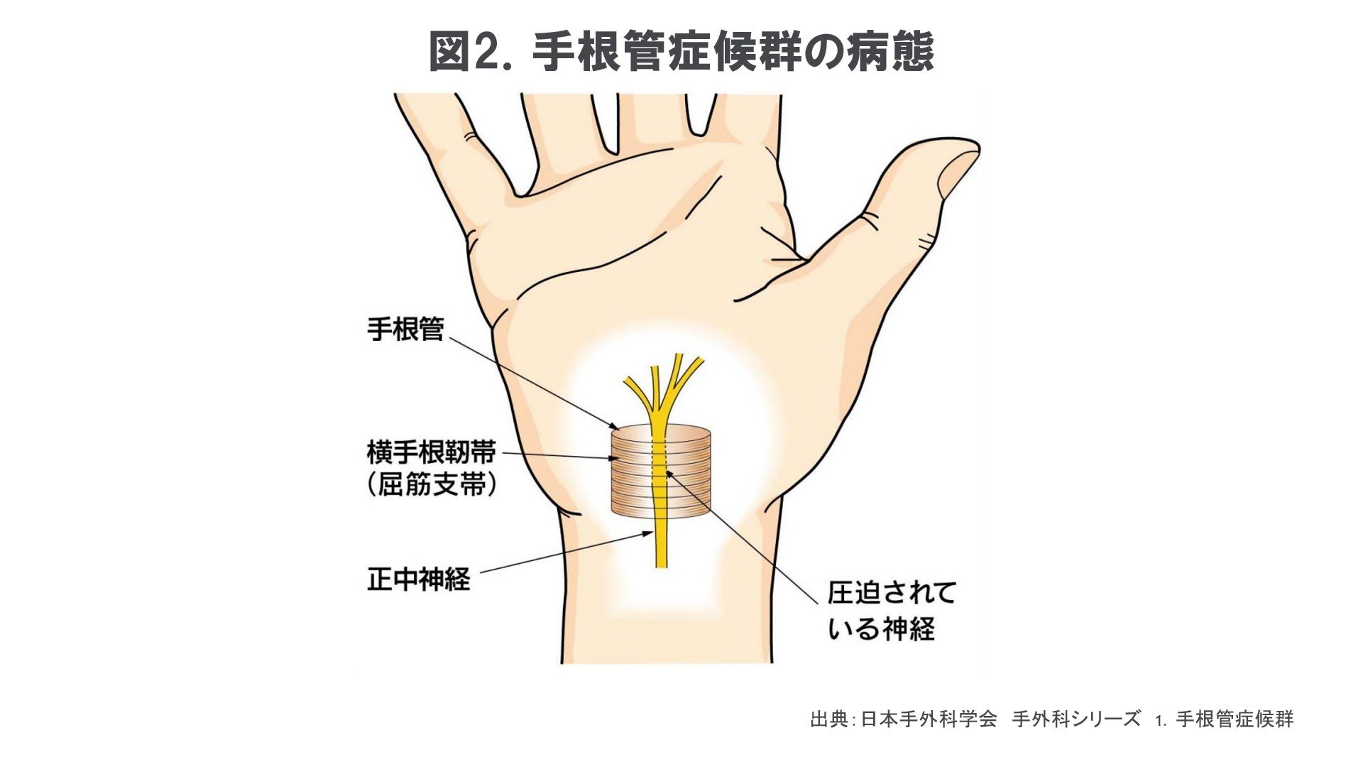 更年期以降の女性に多い手指の疾患