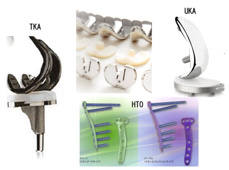 高位脛骨骨切り術（HTO）